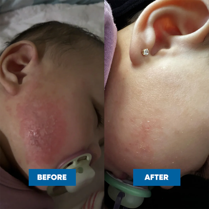 MooGoo Baby Eczema & Psoriasis Cream (120g)